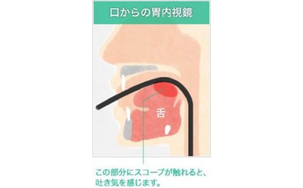 口からの胃内視鏡